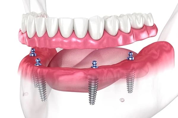 Implant-Supported Complete Dentures in Indore