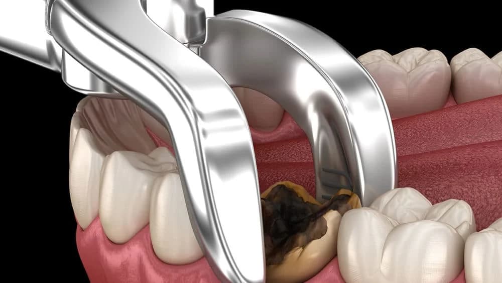 Painless Tooth Extraction in Indore