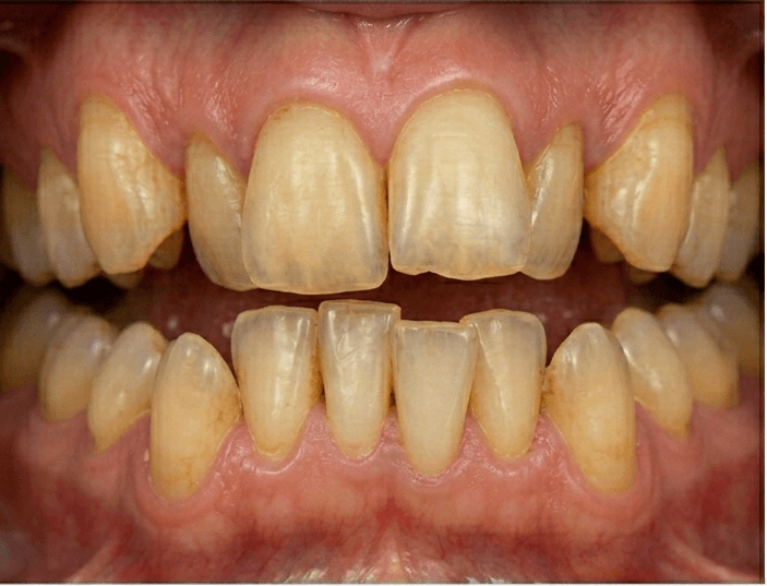 Before treatment