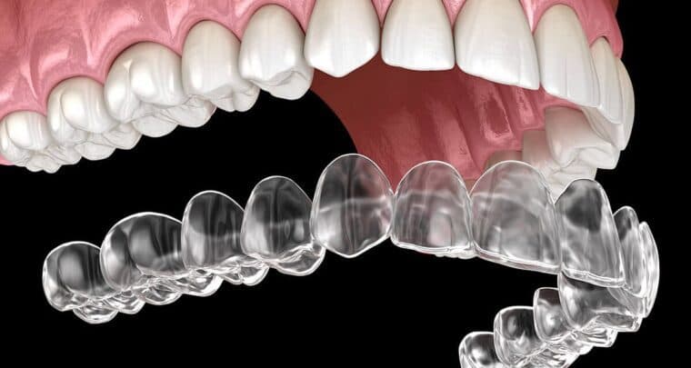 Teeth Alignment with Invisible Aligners