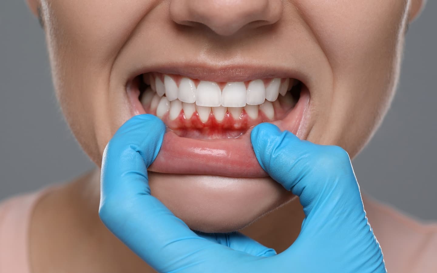 Gum Treatment for Bad Breath and Unpleasant Taste