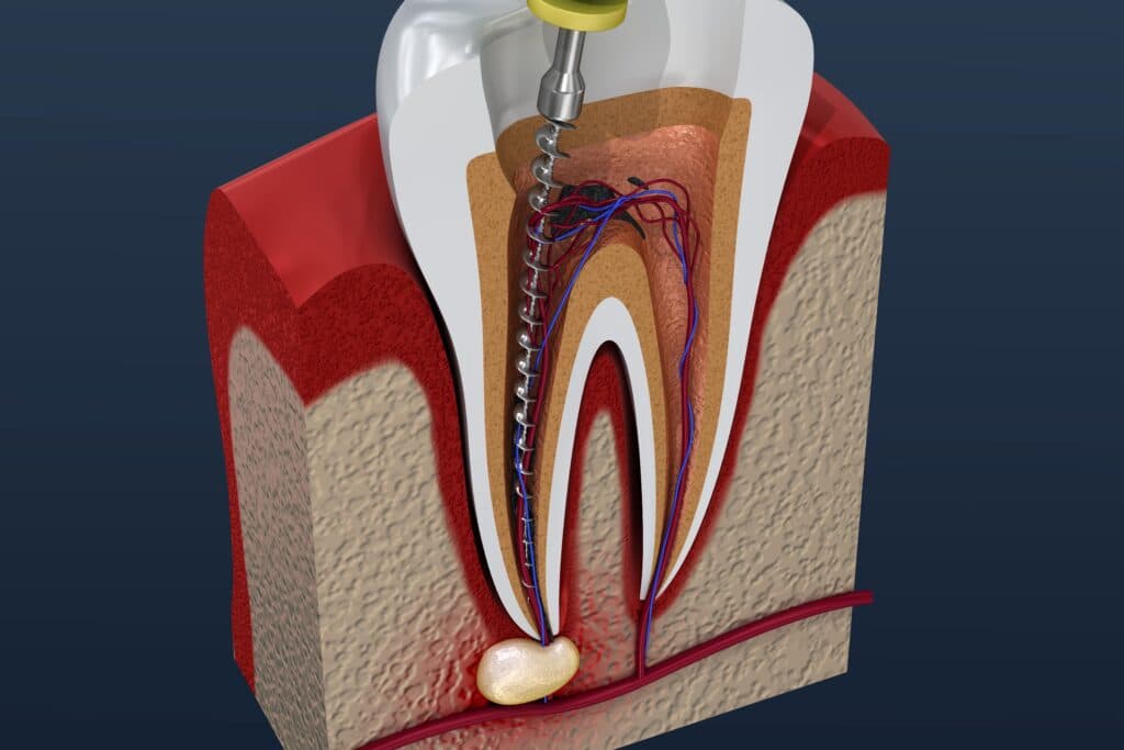 Single-Sitting Root Canal Treatment