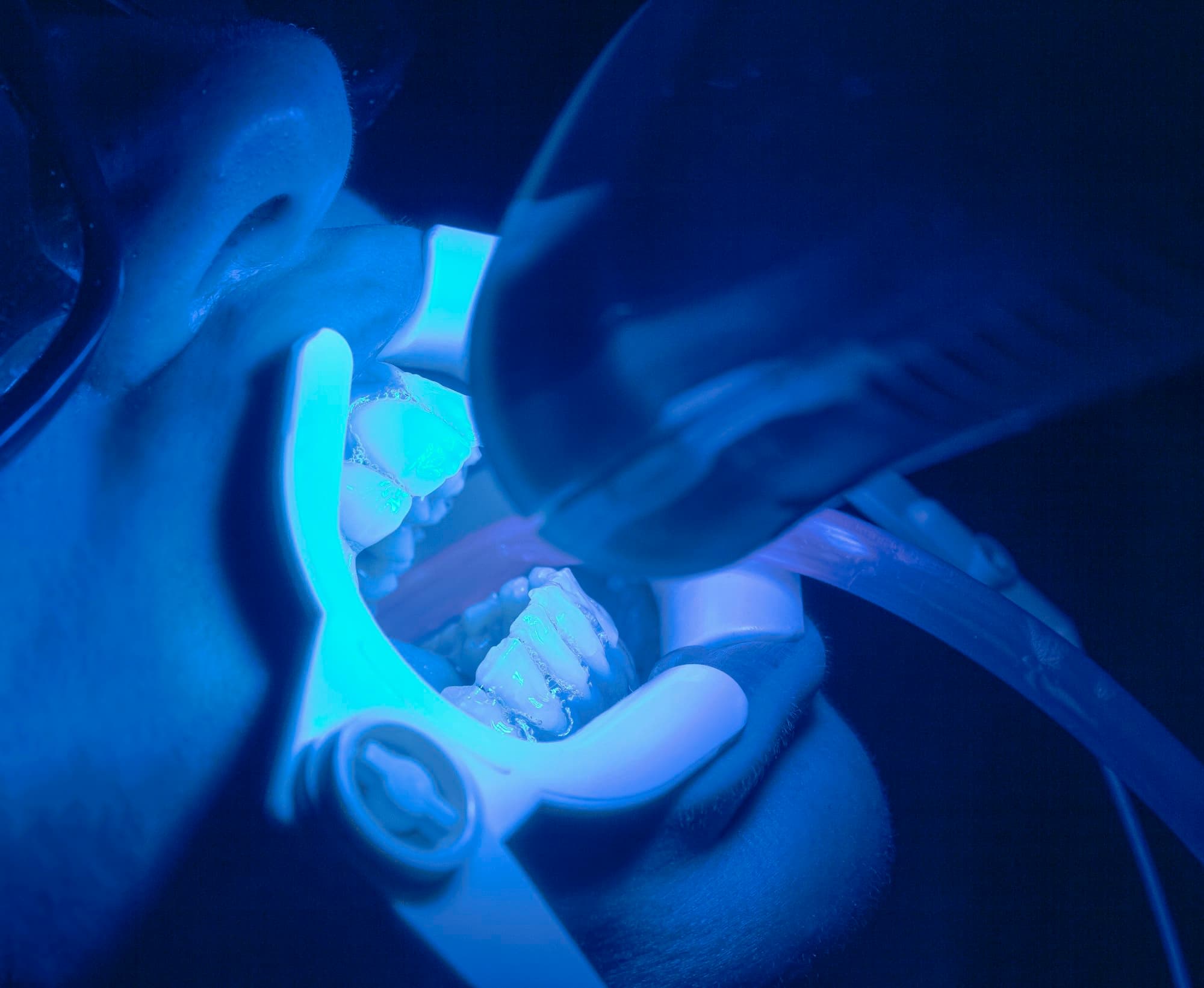 Teeth Stain Removal with Professional Teeth Whitening